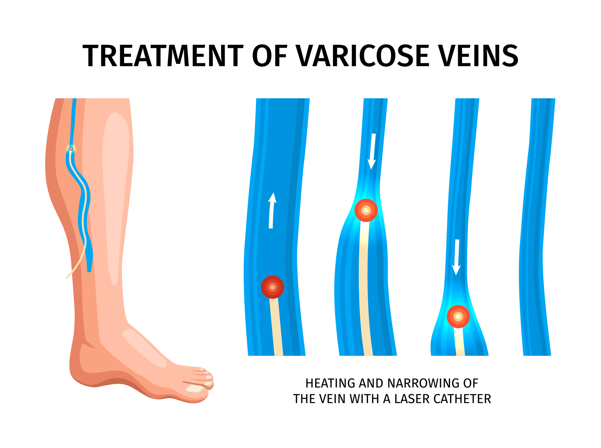 Varicose vein diagnosis identifies venous abnormalities, guiding effective treatment decisions