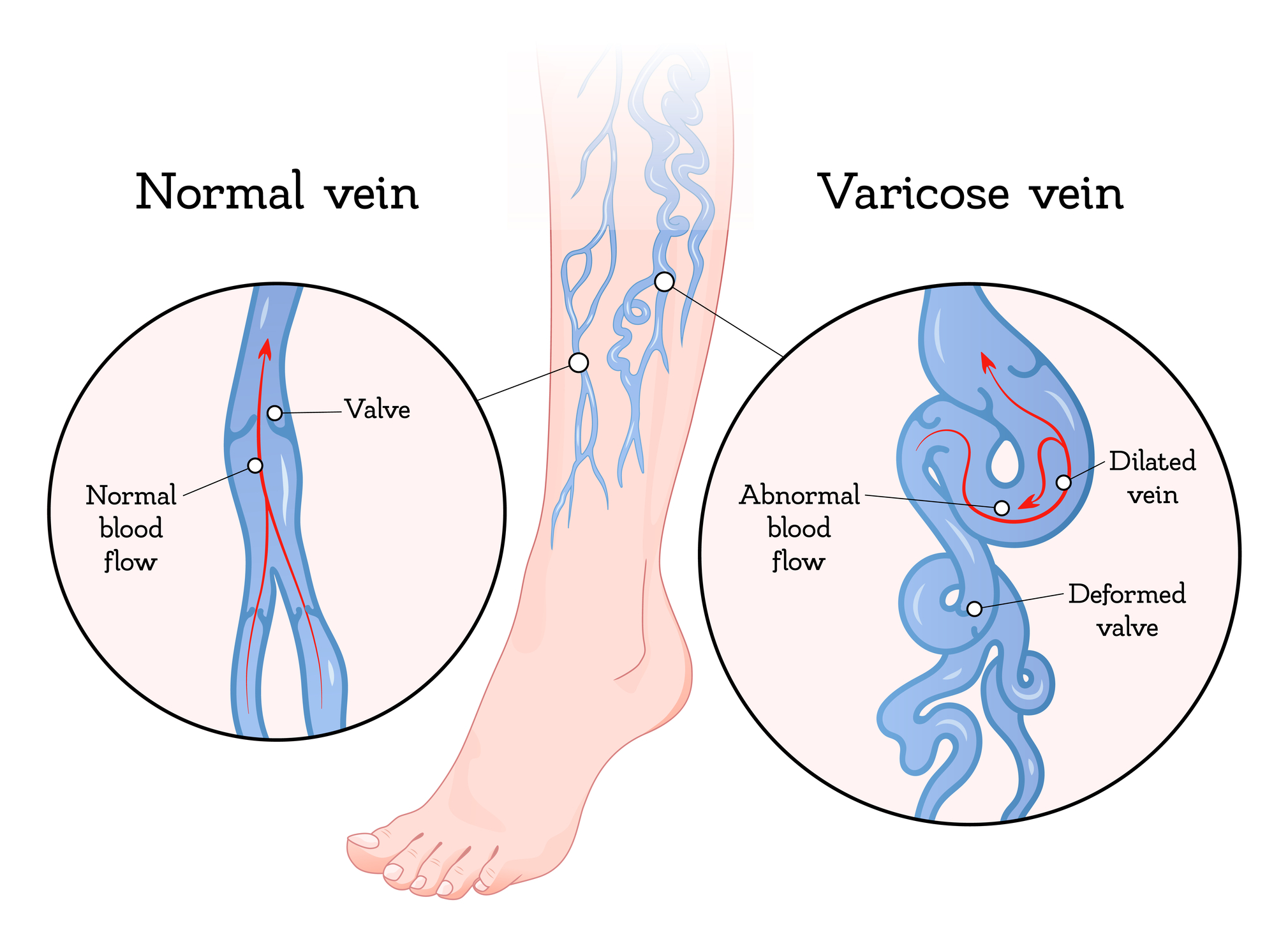 Varicose veins cause swollen, twisted veins that often affect legs