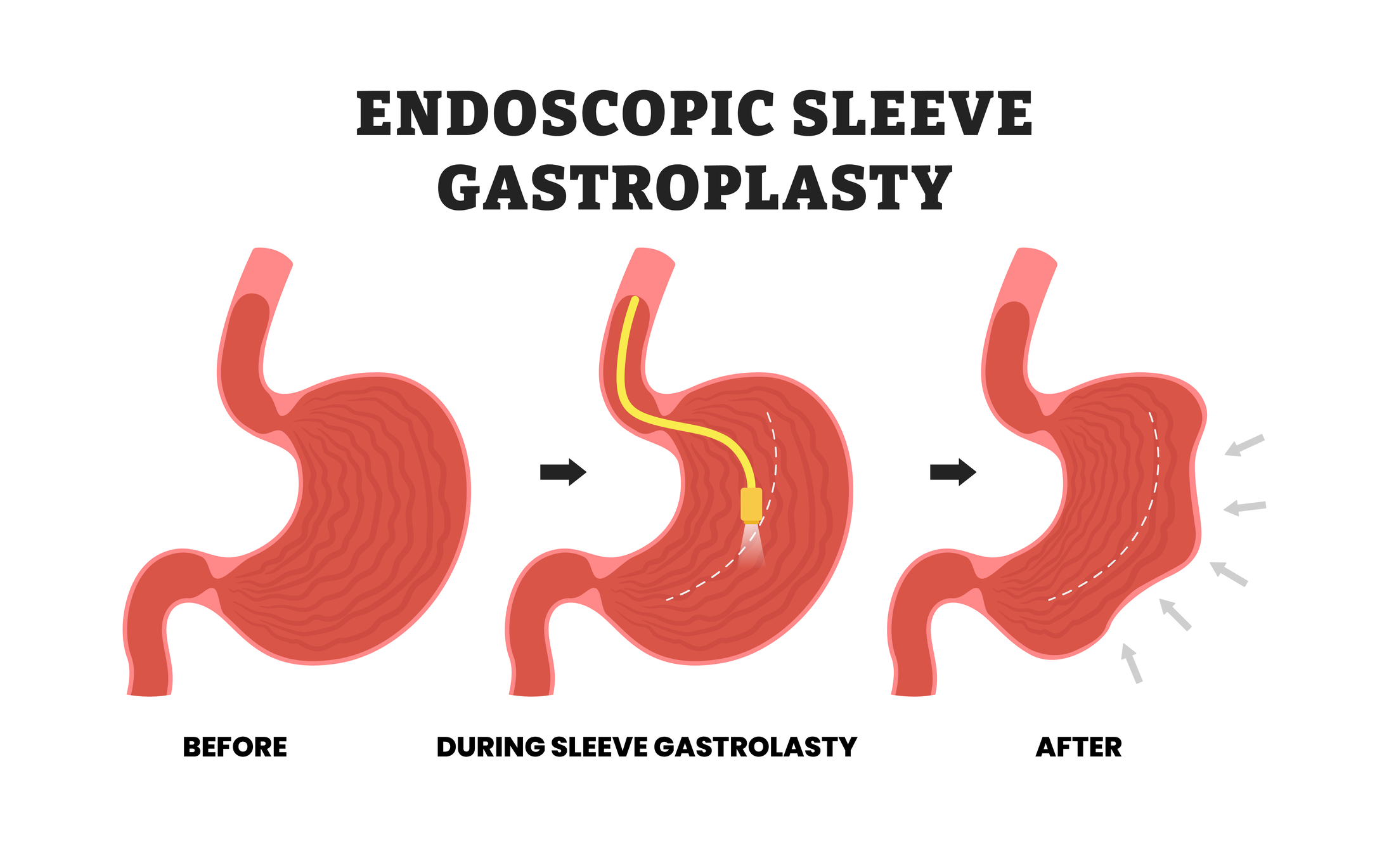 Digital technology supports endoscopic sleeve gastroplasty through connected patient care