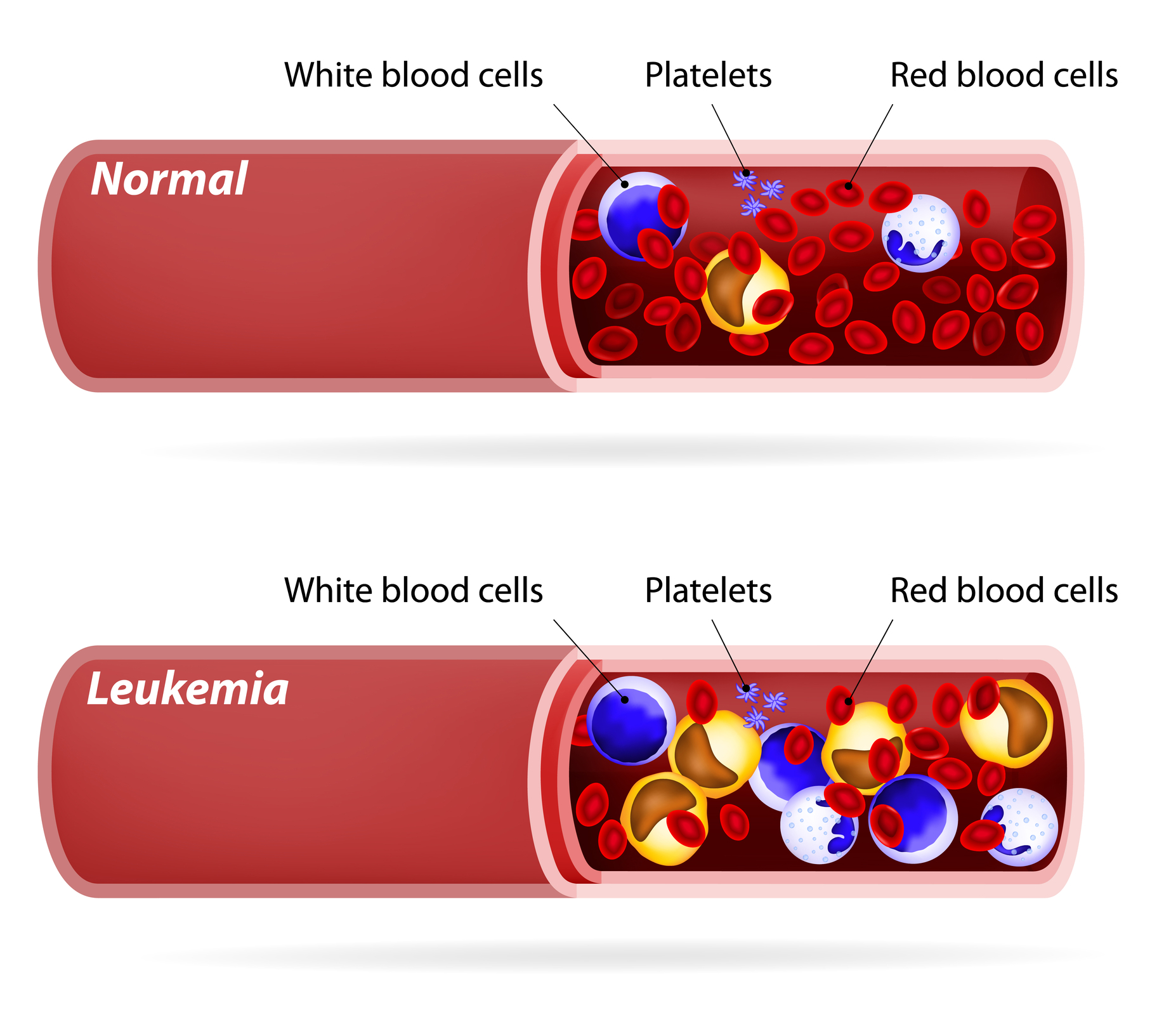 Targeted therapies for chronic lymphocytic leukemia improve patient outcomes significantly