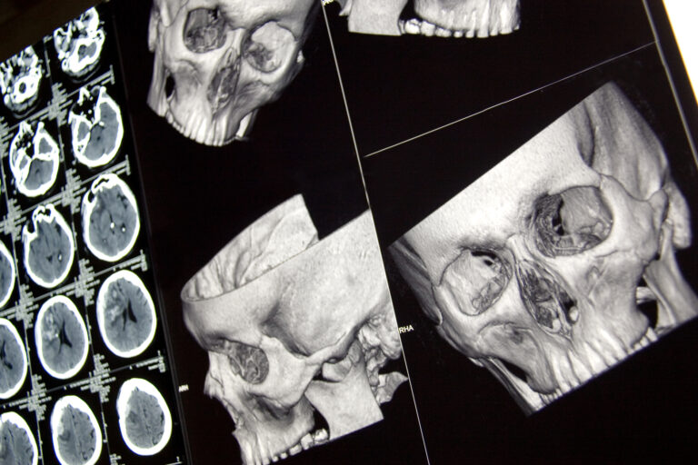 Traumatic brain injury from a road collision requires prompt assessment