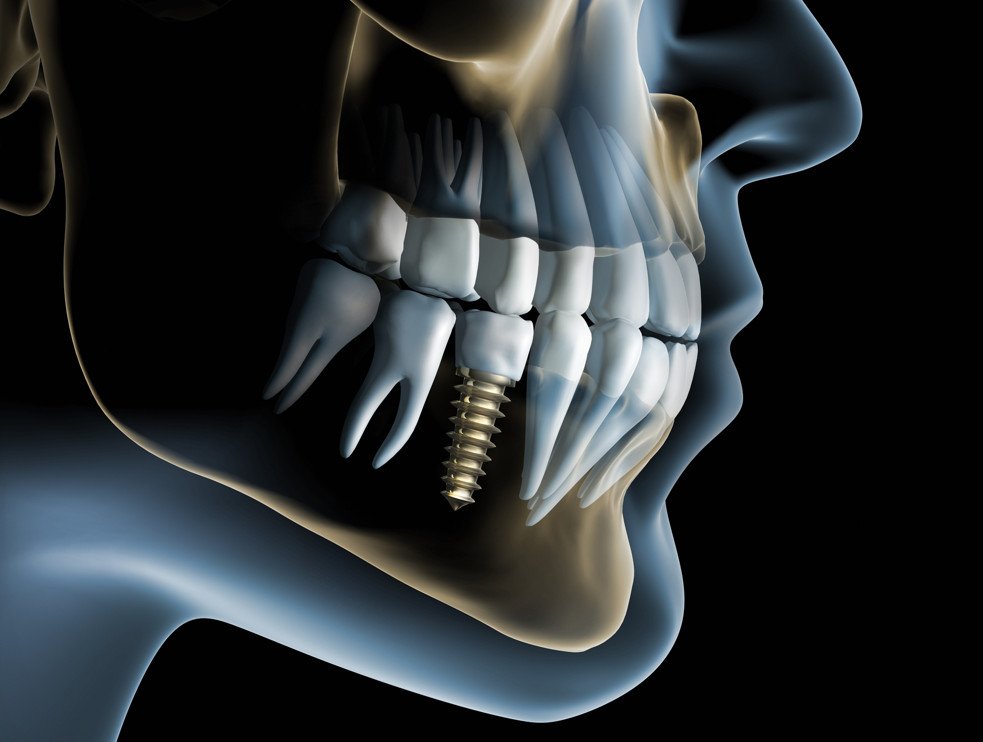 Advanced imaging improves dental implant planning, precision, safety, and outcomes