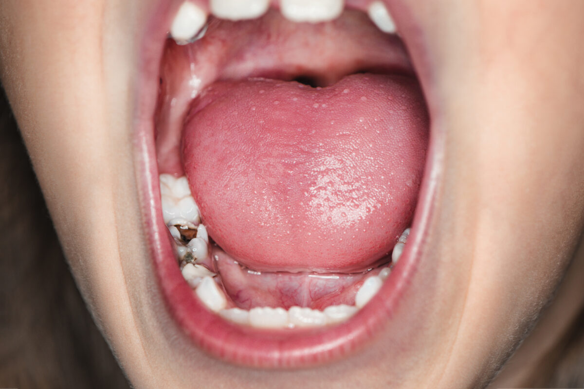 Good dental habits help prevent common dental problems in children